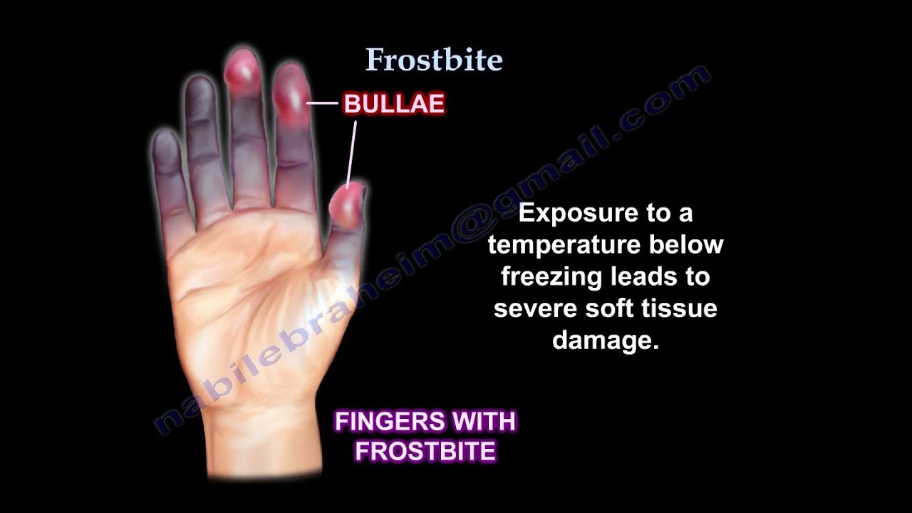 Frostbite UPDATE - Everything You Need To Know - Dr. Nabil Ebraheim