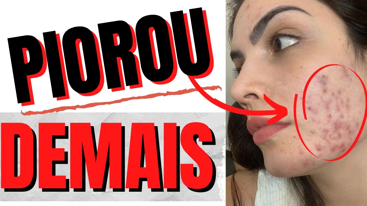 PIOROU MINHA ACNE, ALTA INFLAMAÇÃO - EXPLICANDO TUDO