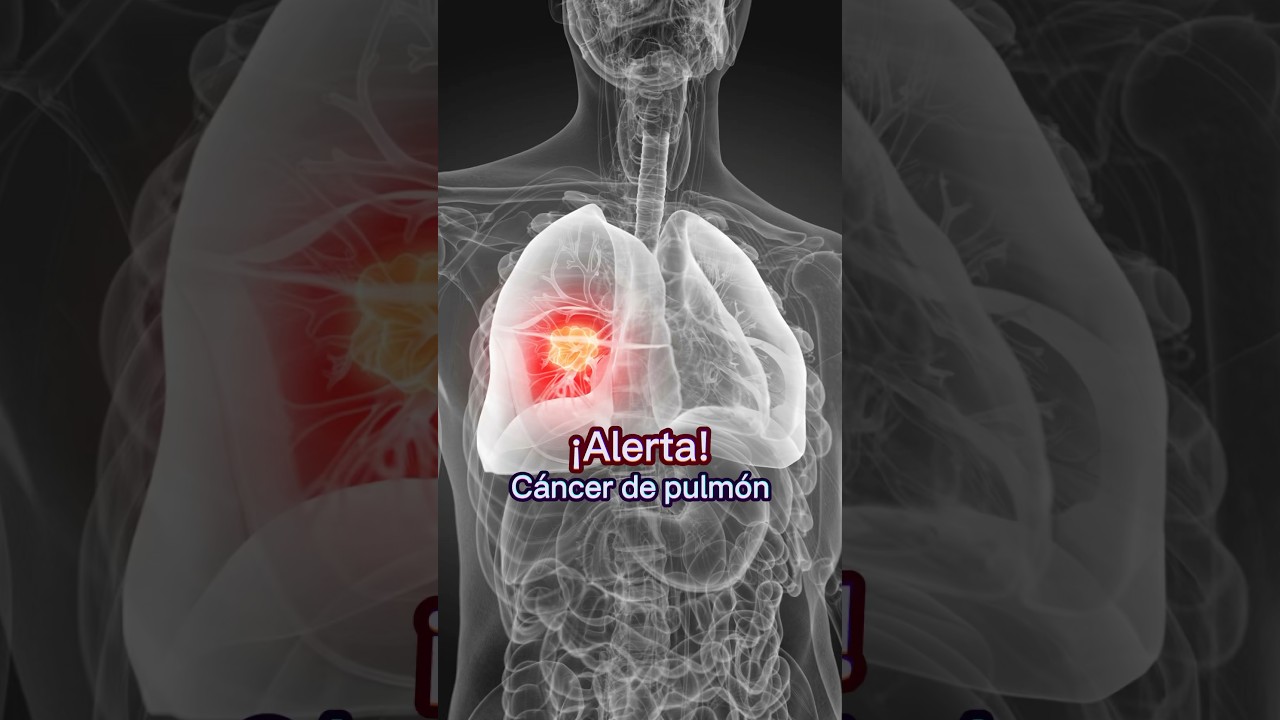 C&aacute;ncer de pulm&oacute;n, &iexcl;no ignores estas se&ntilde;ales! | Dr. William Guerrero. #medicina #shorts
