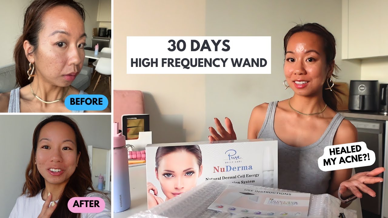 See My 30-Day High Frequency Wand Acne Journey Results