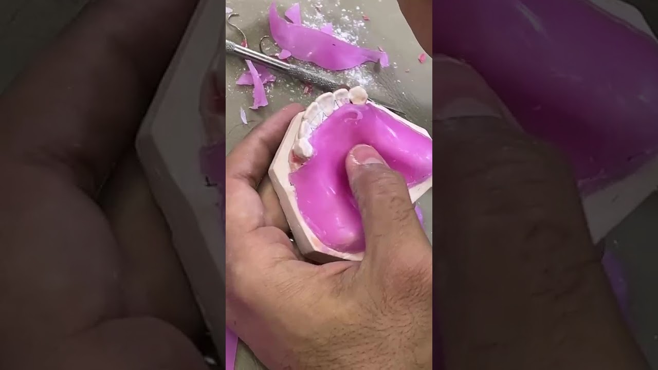 Class I _part 1{ design & bite & mounting Acrylic RPD ,طب أسنان مرحلة ثالثة  }