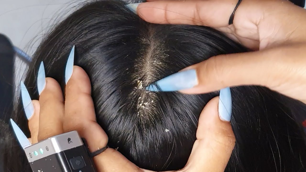 Ultimate Scalp Scratch Relief ASMR 💆‍♀️✨ | Big Flakes, Close-Up Triggers & Pure Calm #VF0043