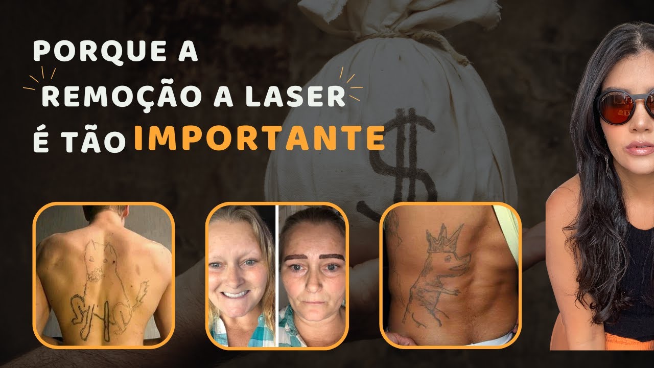 Porque a remoção a laser é tão importante?