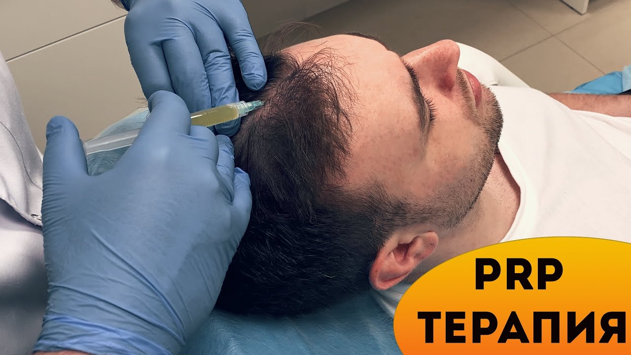 Плазмотерапия (PRP) для волос: Новое слово в борьбе с облысением!