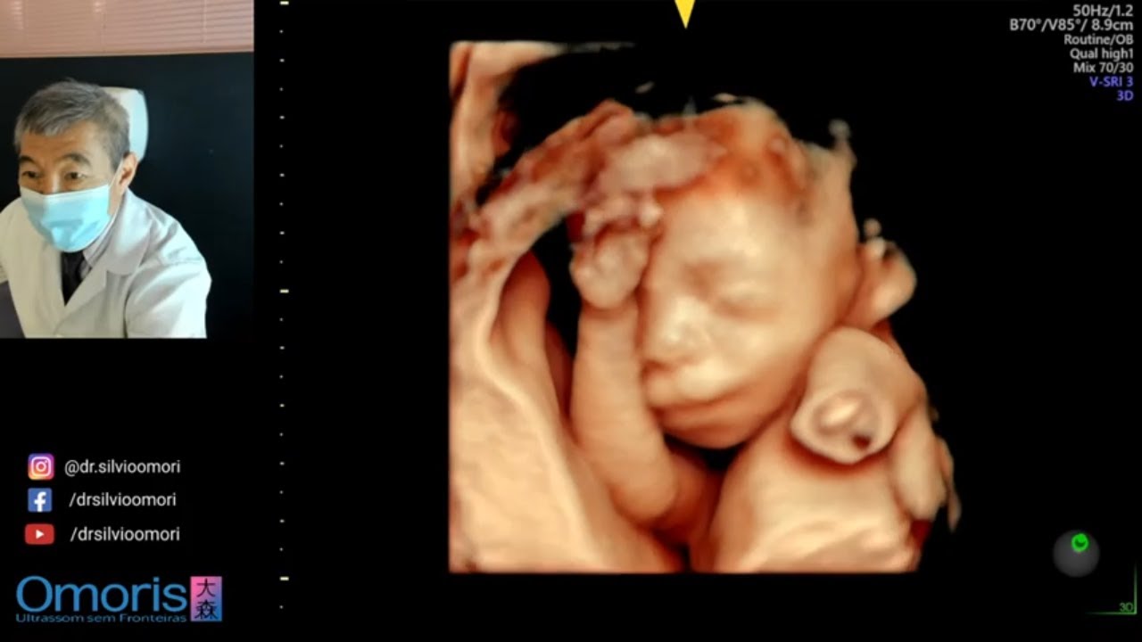 MENINO OU MENINA ? Gravidez 21 semanas.