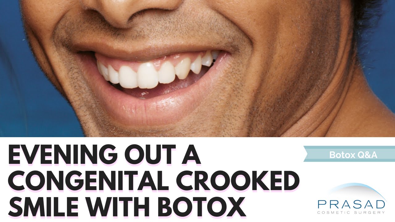Crooked Smile/ Asymmetric Lips Treatment with Botox Injections