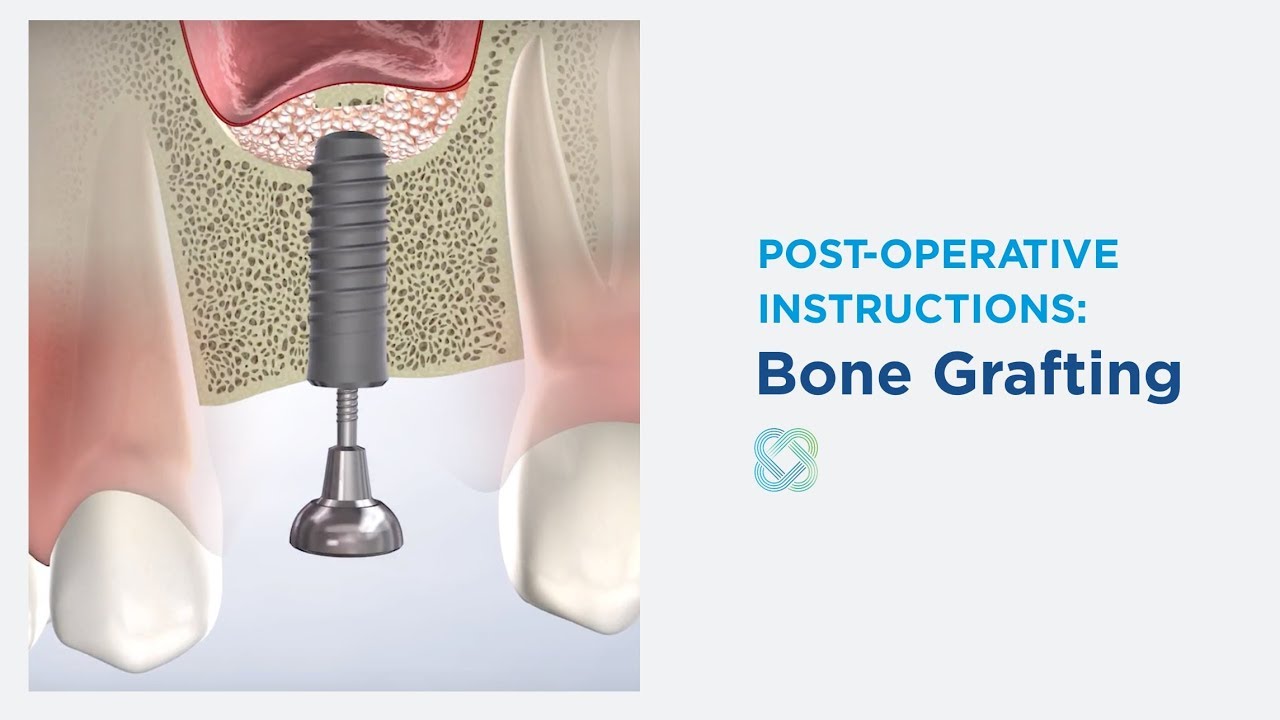 Post-Op Instructions: Bone Grafting at Stephenville Oral Surgery & Dental Implants, Stephenville, TX