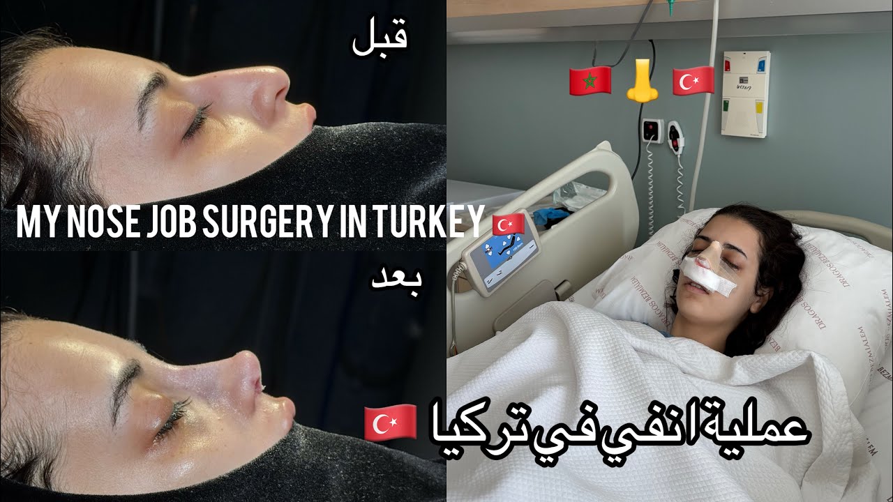 MY NOSW JOB SURGERY IN TURKEY 🇹🇷/🇲🇦 عملية انفي في تركيا
