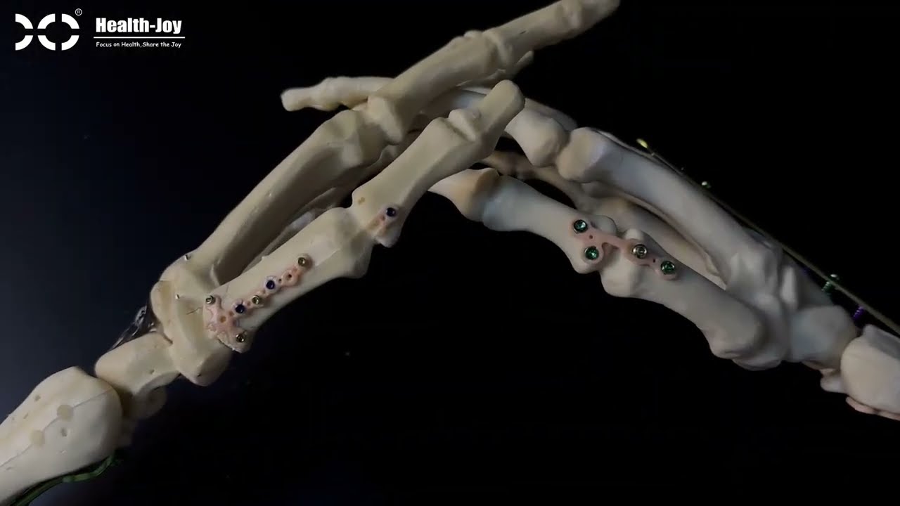 Hand Thumb fixation solution