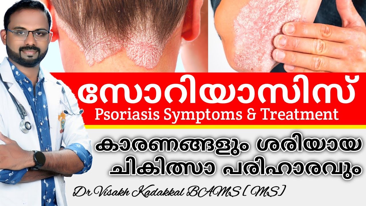 സോറിയാസിസ് | Psoriasis | കാരണങ്ങളും ചികിത്സാ പരിഹാരവും | Symptoms & Treatment | Dr Visakh Kadakkal