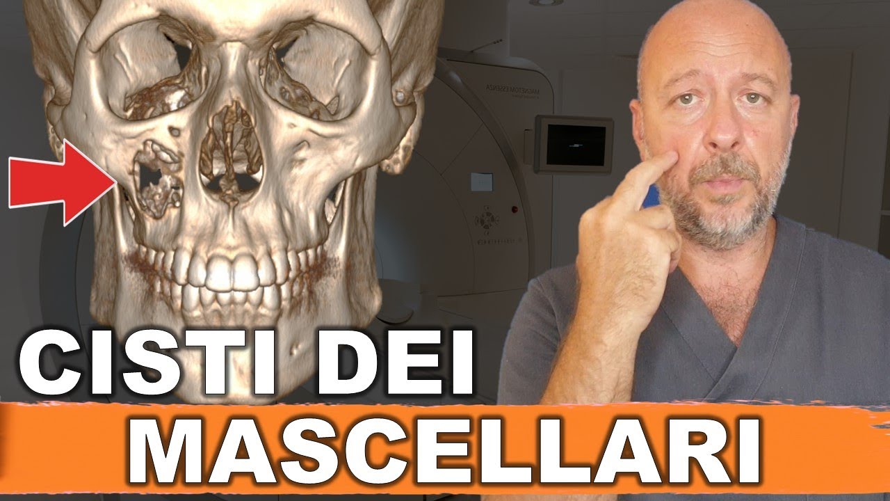 Raramente si vede una CISTI del MASCELLARE così grande.