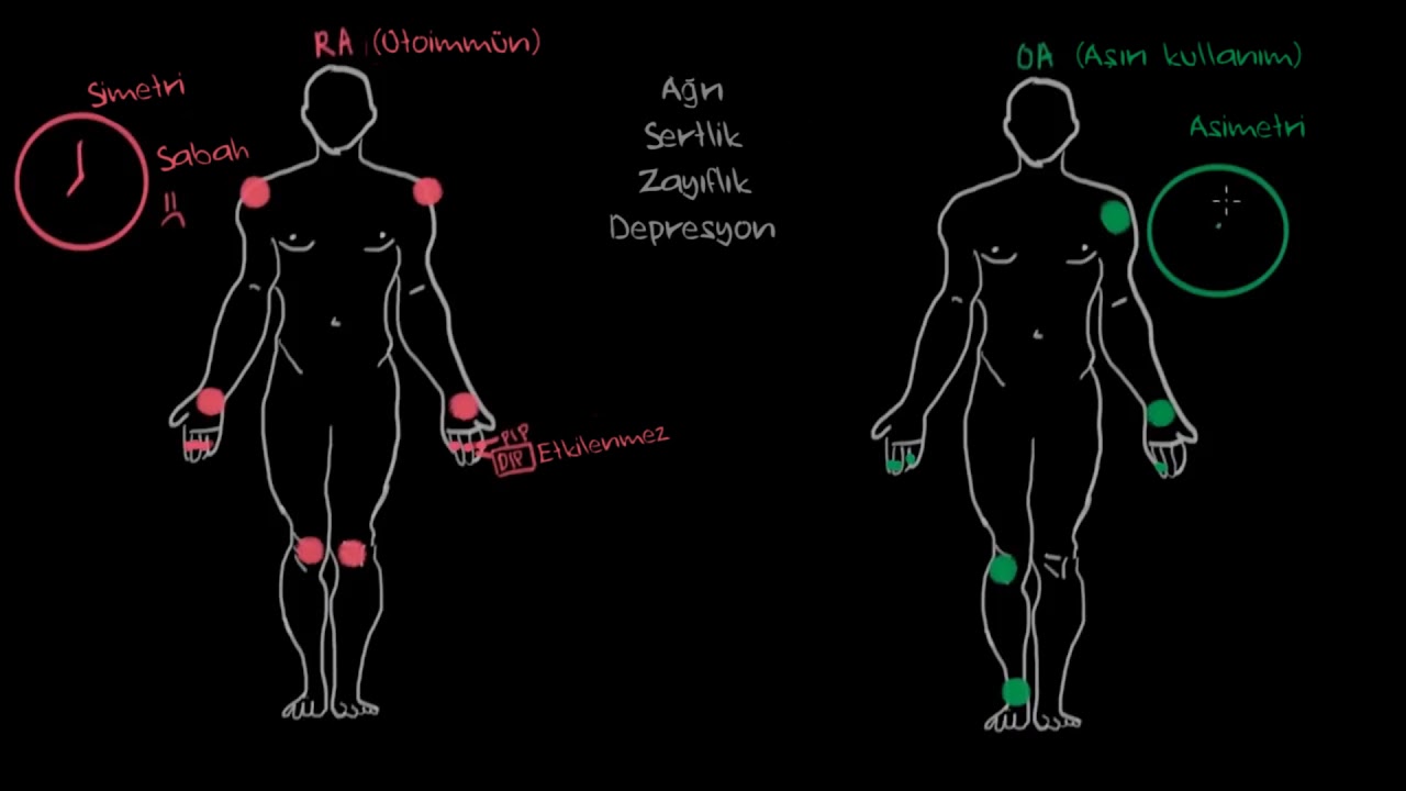 Osteoartrit ve Romatoid Artrit Semptomları (Fen Bilimleri) (Sağlık ve Tıp)