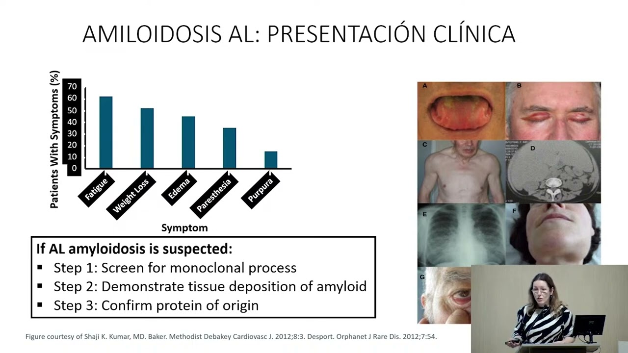 HEMATOLOGÍA PARA NEFRÓLOGOS. TRATAMIENTO ACTUAL DE LA AMILOIDOSIS AL.