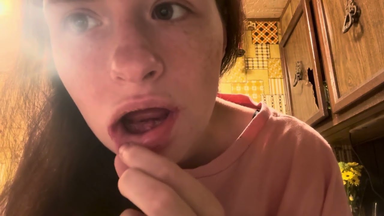 Day Two After Surgery | Lots of Pain, Getting Hungry, Super Tired 