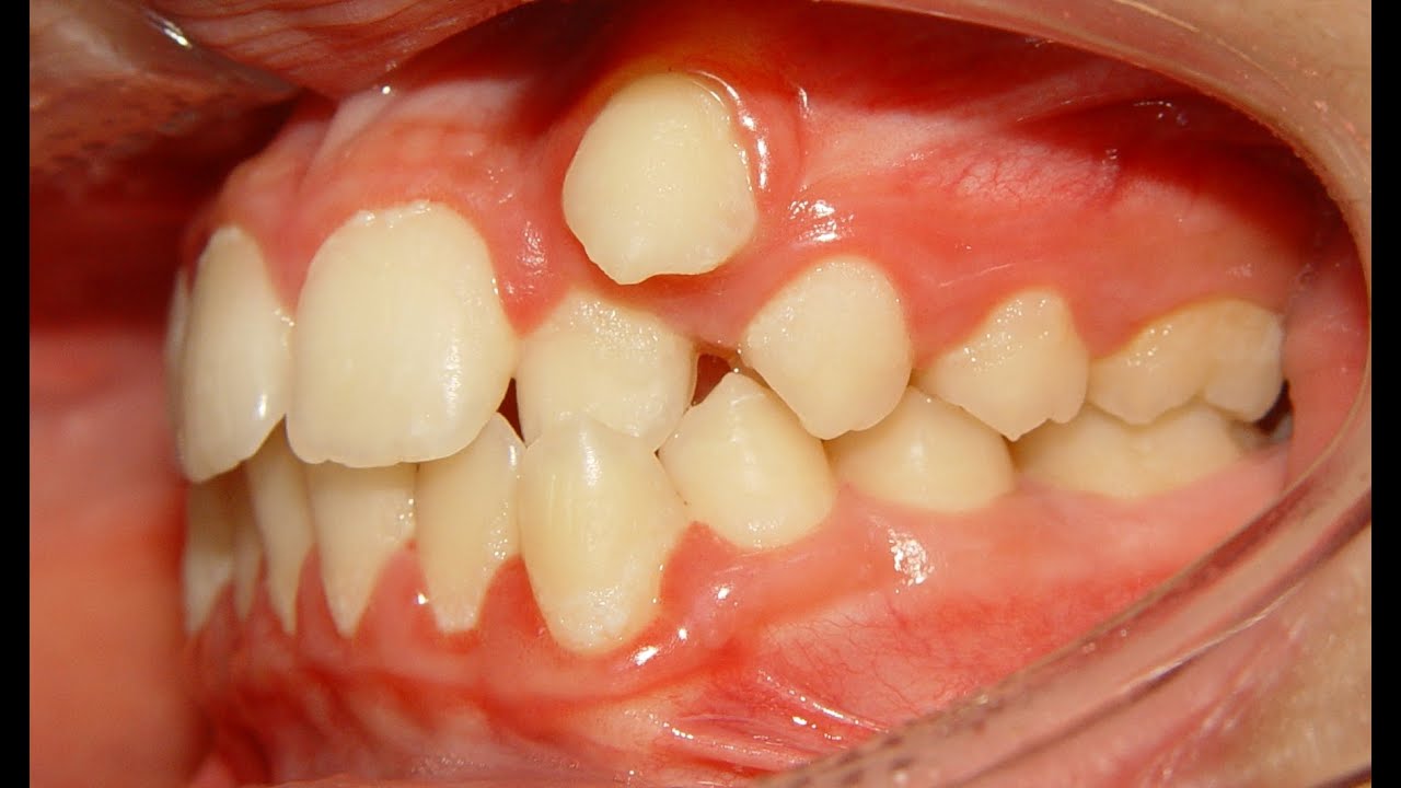 Orthodontic Treatment of Ectopic Upper Canine - No Extraction (Salah 12yrs)