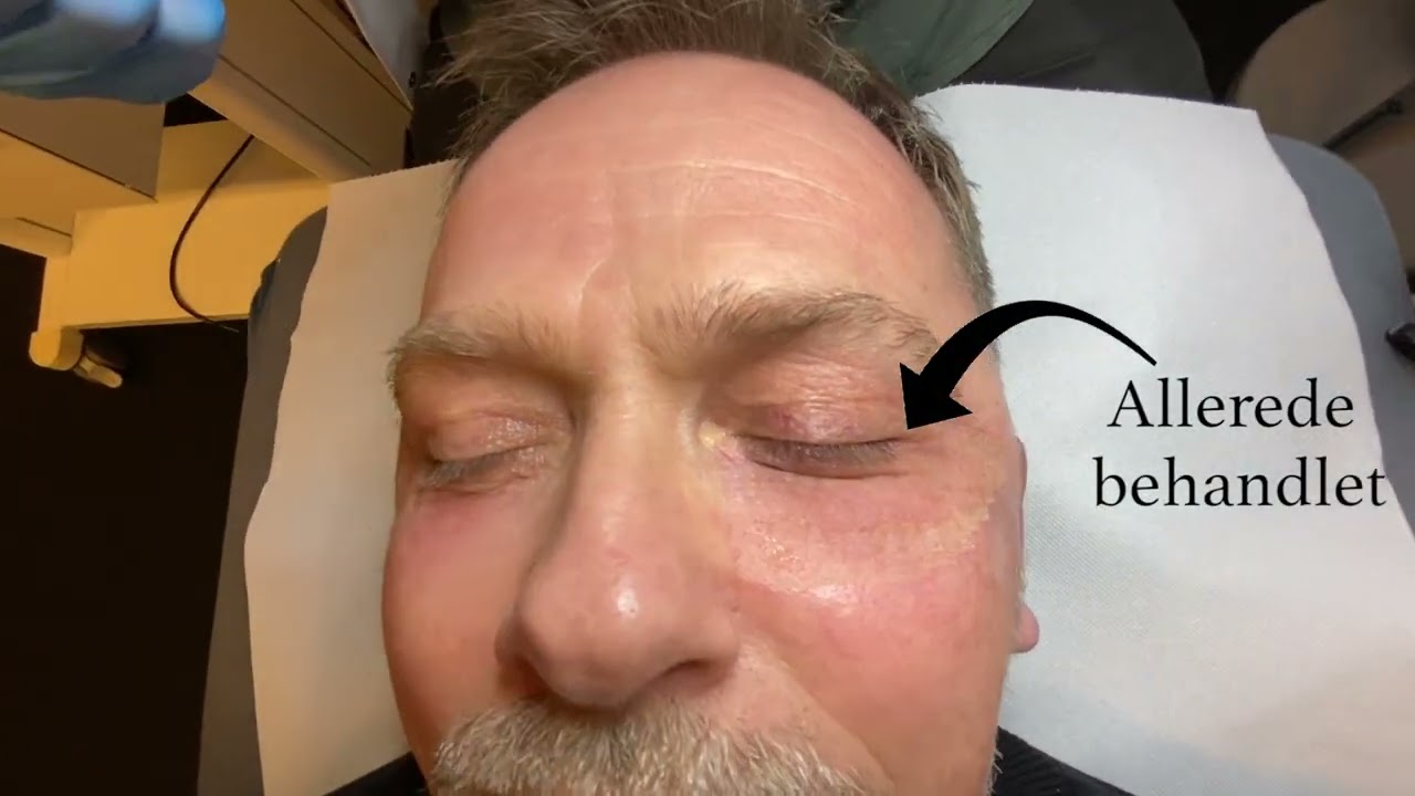 Co2 laser behandling - Anti-age