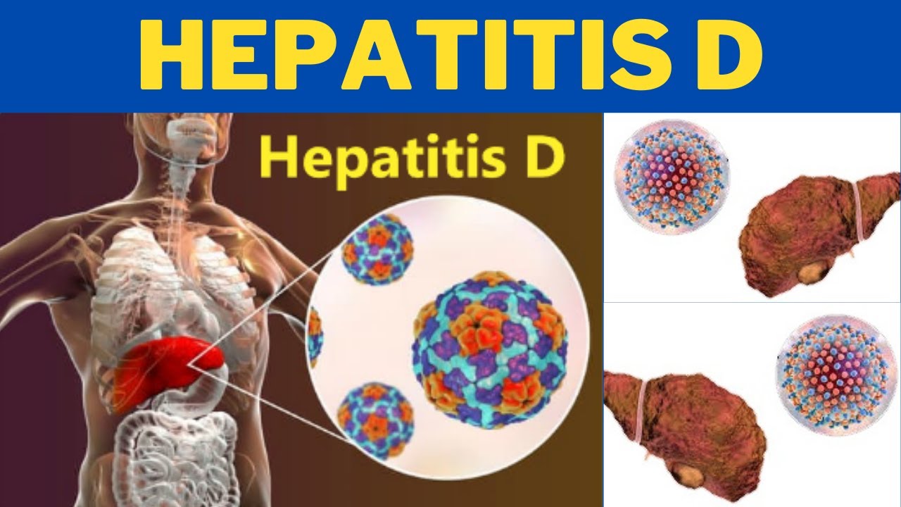 Hepatitis D (HDV) - How do you get hepatitis D? | 247nht