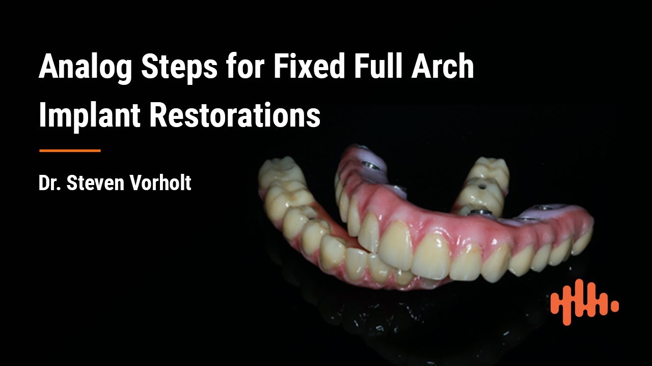 Analog Fixed Full Arch Restoration Steps - Dr. Steven Vorholt