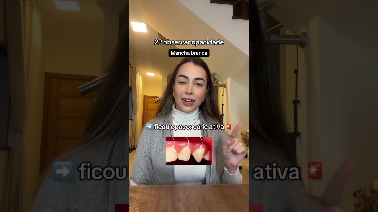 C&aacute;rie ativa e inativa! Como identificar e tratar corretamente 🦷 #odontologia #cariologia #carie