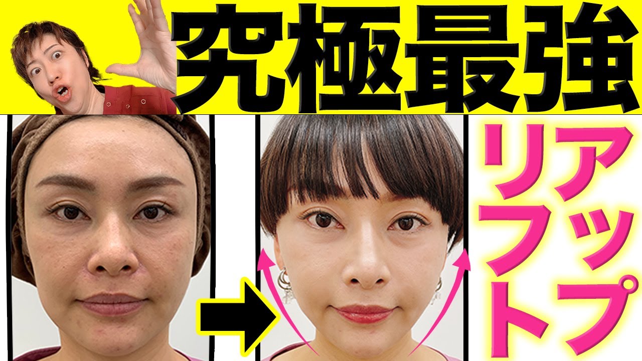 【たるみ改善】ただの糸リフトじゃない！たるみを完全に消します！