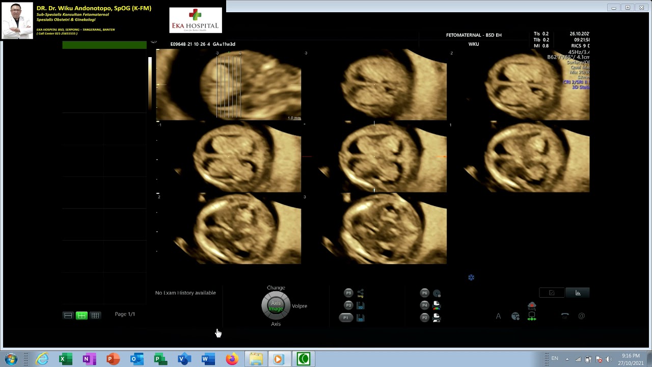 FETAL HIDROPS - MULTICYSTIC HYGROMA - TRISOMI 21 Down Syndrome (Dr Wiku Andonotopo)