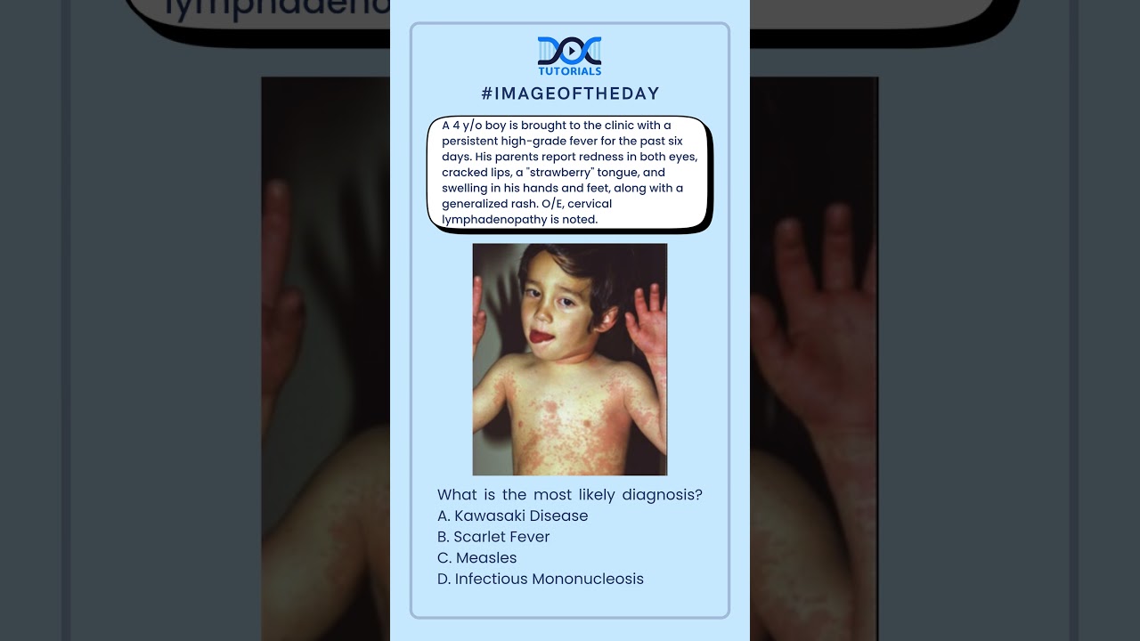 Fever, Rash, and Strawberry Tongue in a 4-Year-Old: What&rsquo;s the Diagnosis?