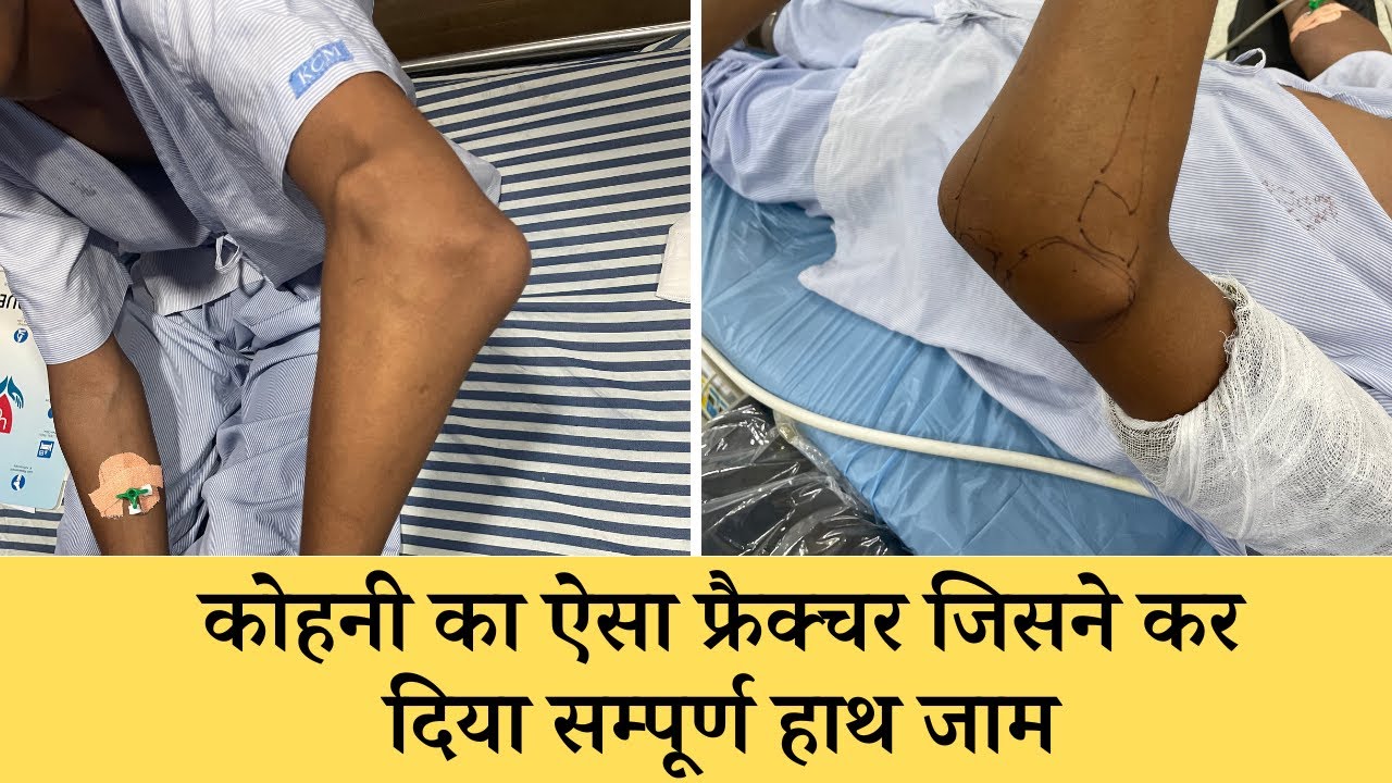 बचपन की कोहनी का फ्रैक्चर और टेड़ापन का हुआ सफल इलाज माँ हुई भावुक | Elbow Jammed Treatment