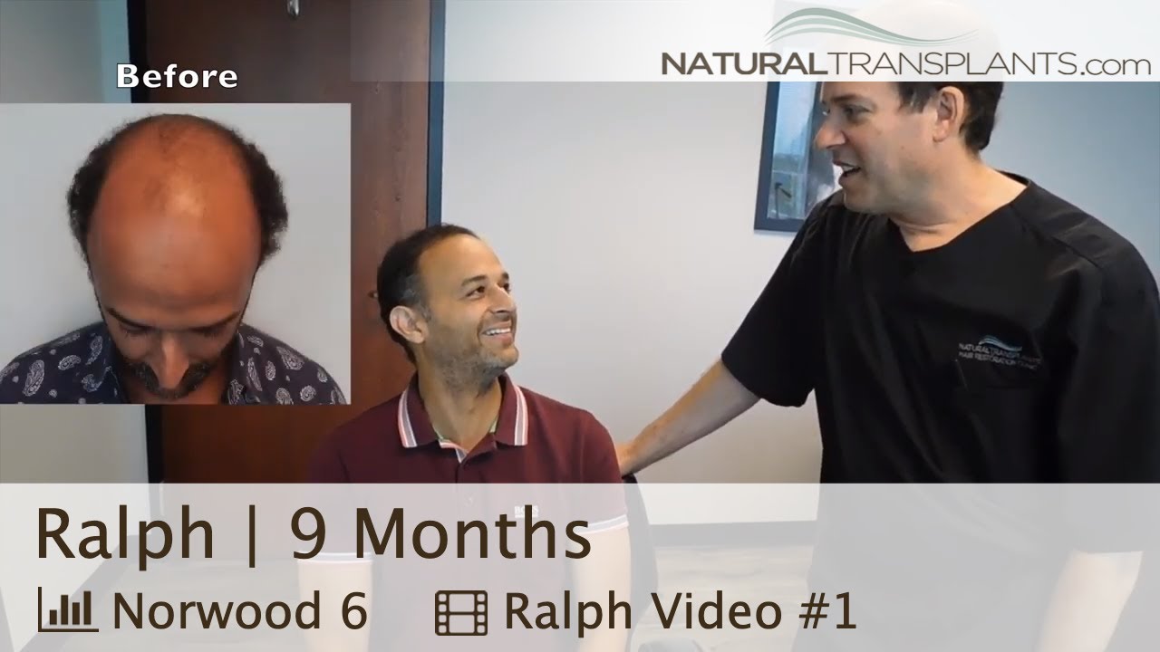 Hair Transplant Results After 9 Months 