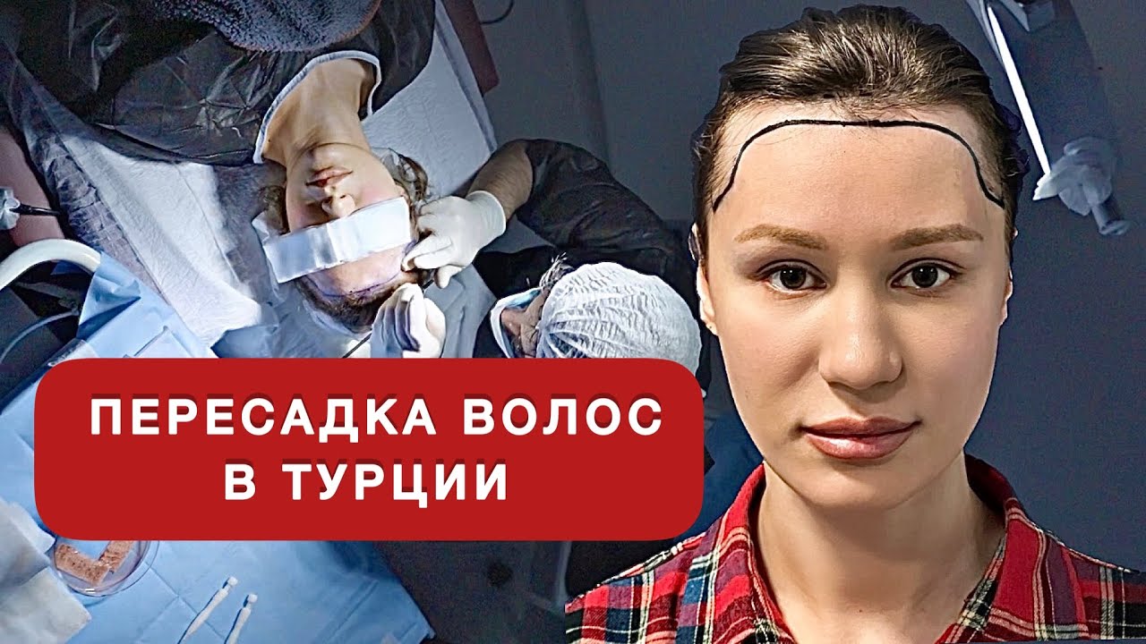 ЖЕНСКАЯ ПЕРЕСАДКА ВОЛОС! результат через 10 дней