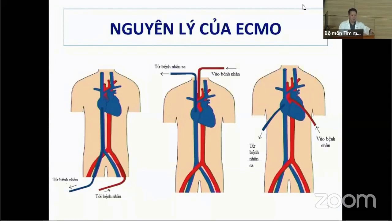 Thiết bị hỗ trợ và thay thế tuần hoàn (IABP, ECMO) và thận (siêu lọc) | CẤP CỨU TIM MẠCH (buổi 3)