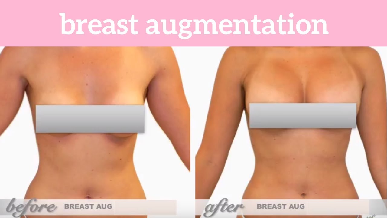 Melisa Visits Lift MD Aesthetics for a Breast Augmentation & Body Sculpting