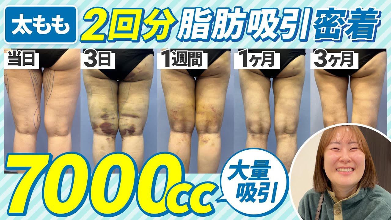 【厳選ドクターによる2回に分ける太もも脂肪吸引】湘南美容外科のカウンセラーさんのダウンタイムに密着しました【合計で7000cc吸引】
