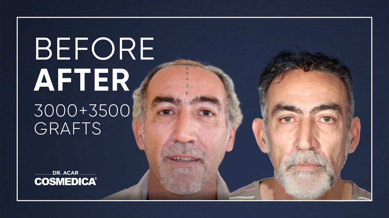 COSMEDICA DR.ACAR ,3500 Grafts  FUE Hair Transplant,Turkey-Istanbul