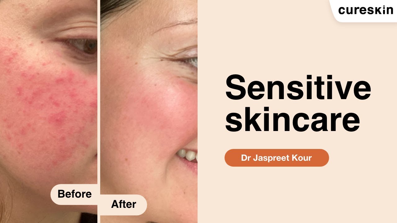 4 mistakes to avoid and 6 must-follow tips for sensitive skin - Senior dermatologist | Cureskin