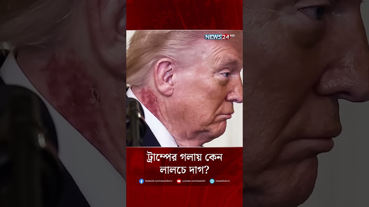 ট্রাম্পের গলায় কেন লালচে দাগ? | NEWS24