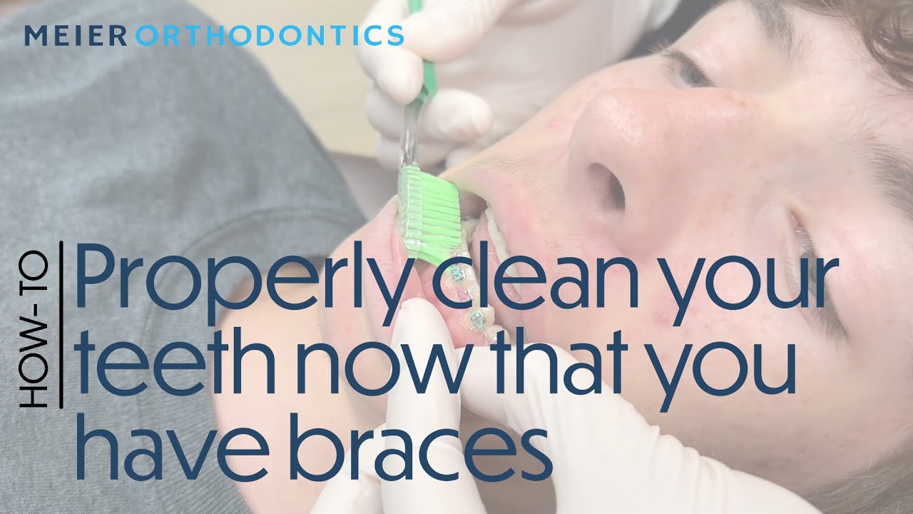 You're not cleaning your teeth properly if you have braces 🥴