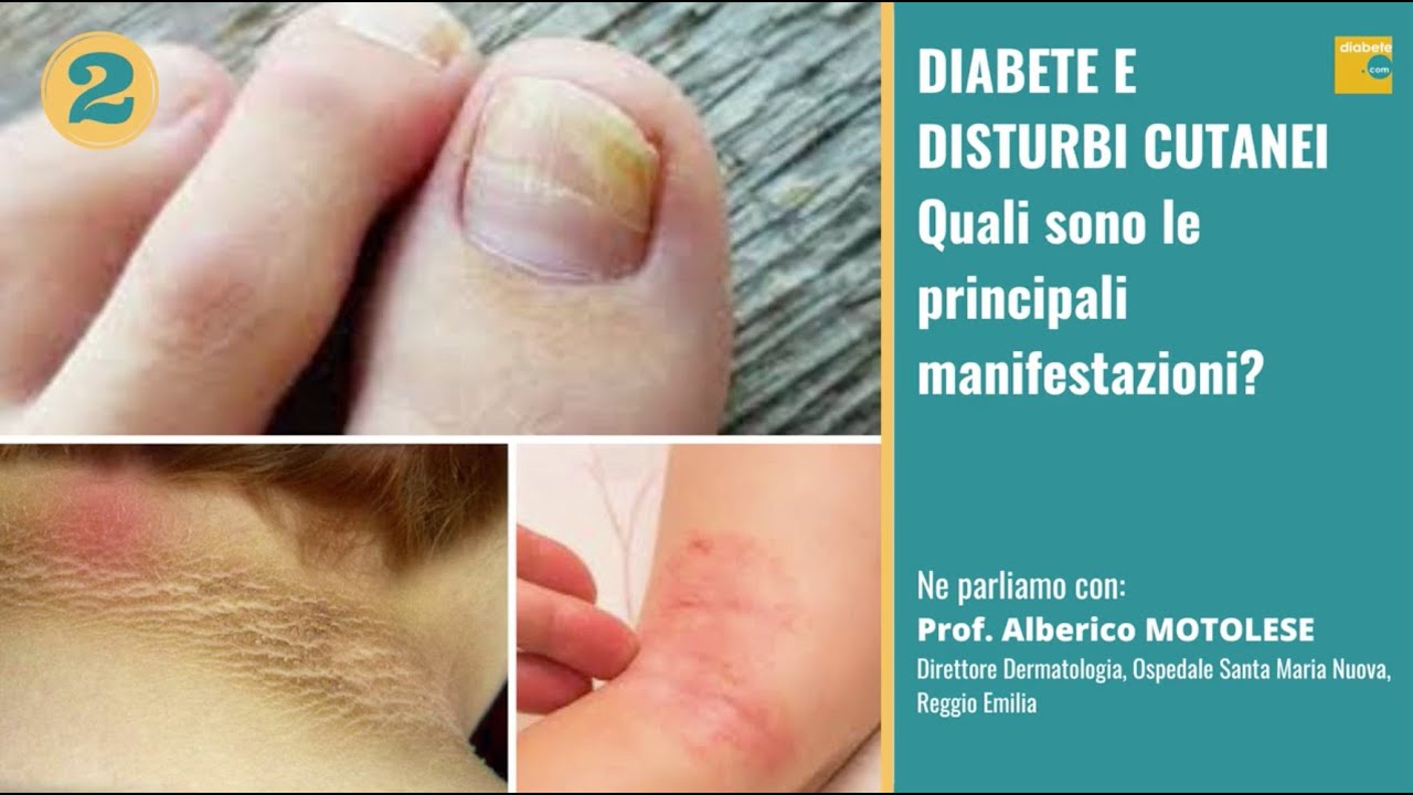 Diabete e disturbi cutanei: quali le principali manifestazioni?