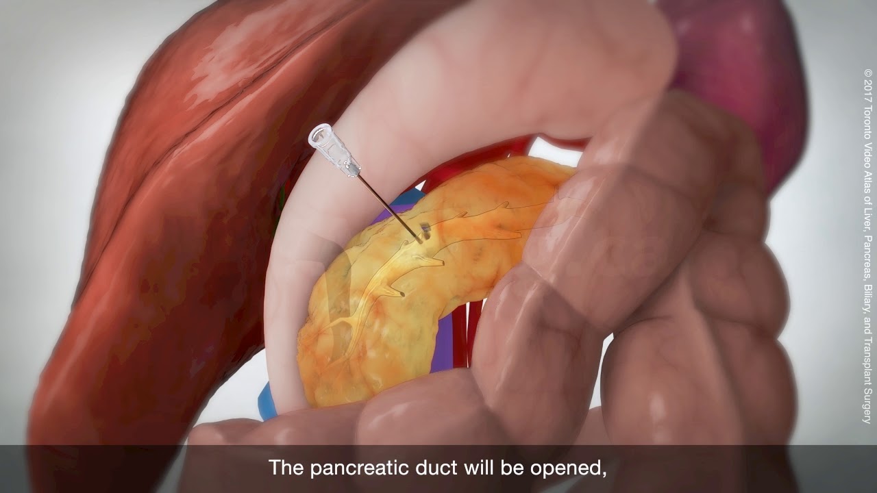 Longitudinal pancreaticojejunostomy (Puestow procedure)