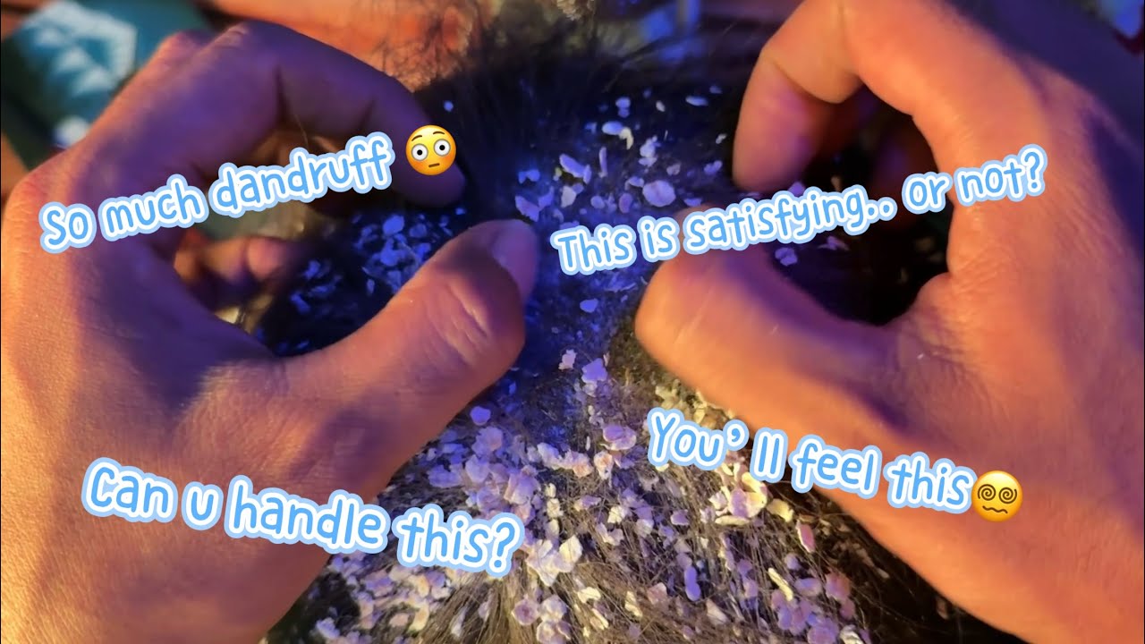 JANGAN DITONTON KALAU GAK KUAT 🤯 Garuk Rambut Penuh Ketombe | Extreme Dandruff ASMR