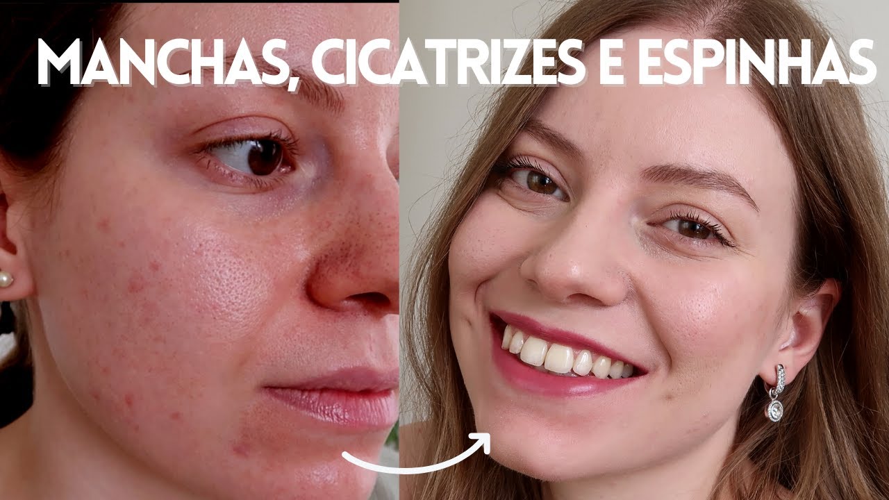 Maquiagem para Pele com Acne que NÃO Provoca Mais Espinhas ❣️