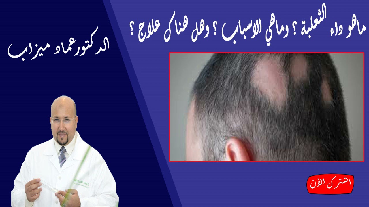ماهو داء الثعلبة ؟ وماهي الاسباب ؟ وهل هناك علاج ؟ الدكتور عماد ميزاب