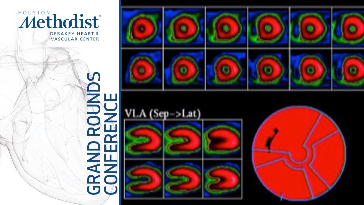 Predicting Risk & Guiding Therapeutic Decision-making in Stable CAD (Mahmarian, MD) April 30, 2020