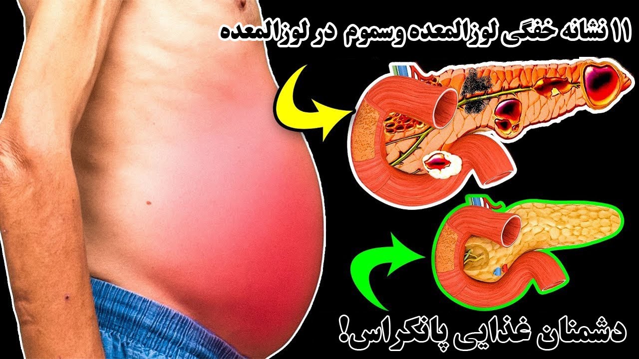 نشانه های که از نار سایی پانکراس خبر میدهد!