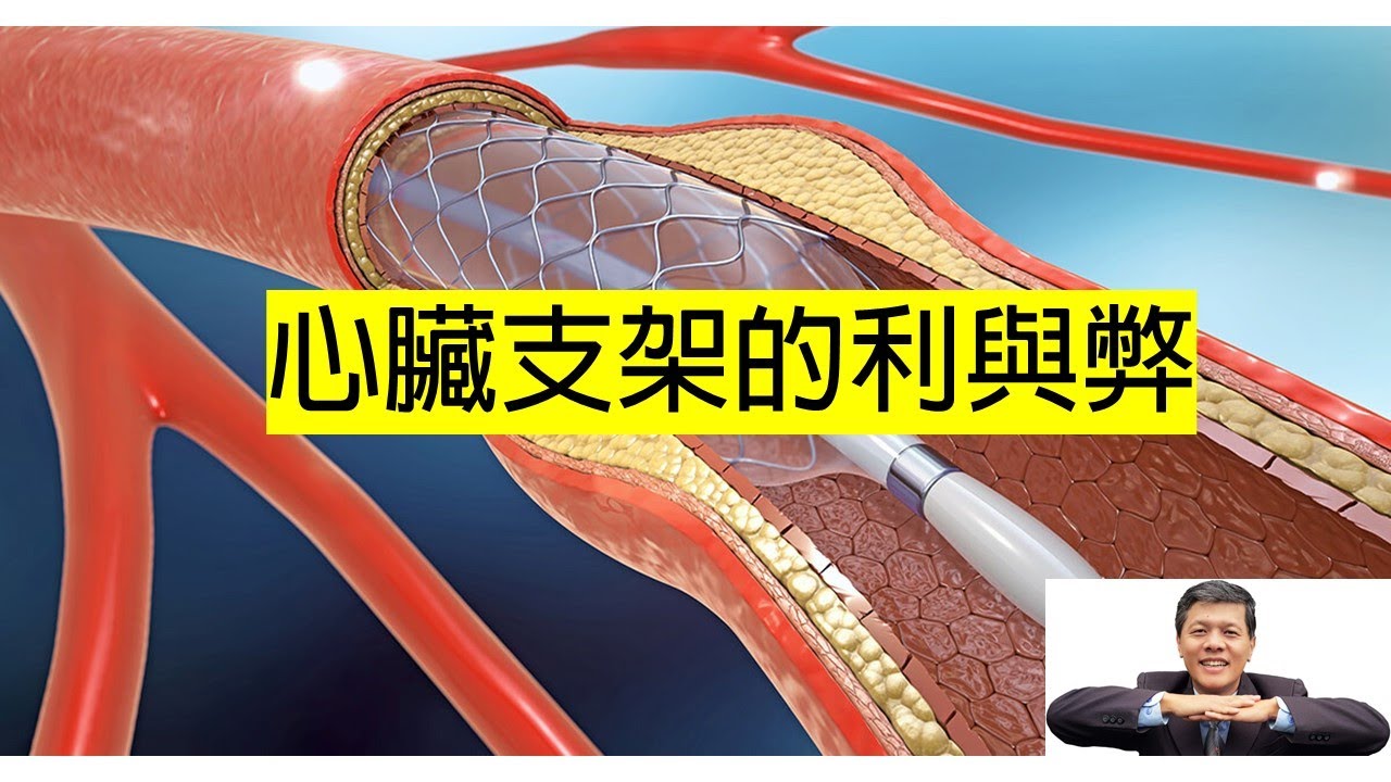 心臟支架利與弊：塗藥支架比較好？ 如何改善味蕾？降低血管阻塞