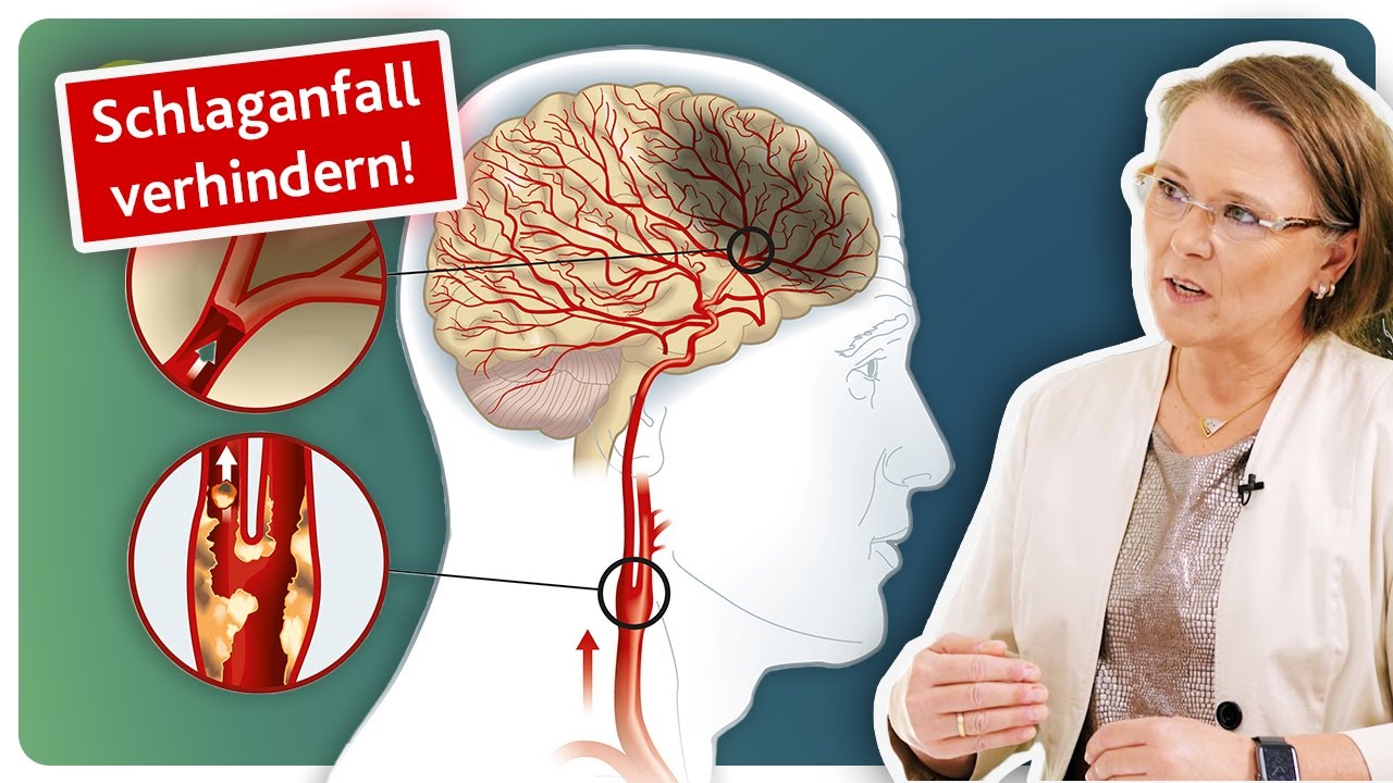 Verengung der Halsschlagader rechtzeitig erkennen | Diagnose & Behandlung