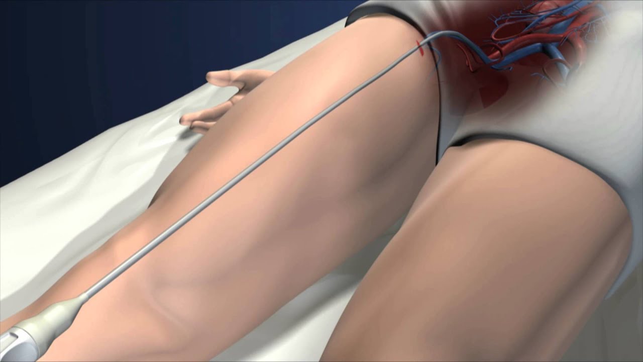 OptionELITE Retrievable Vena Cava Filter