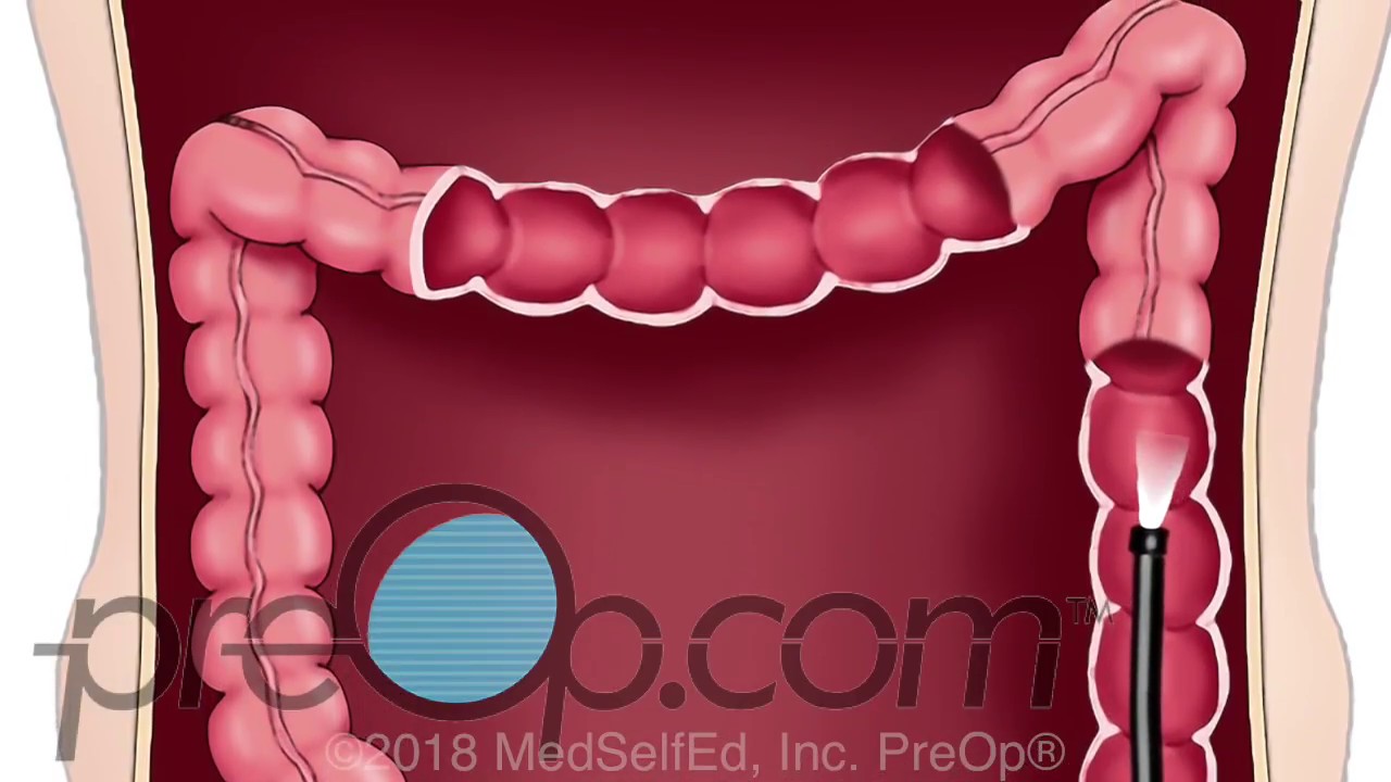 Lower Endoscopy - Lower GI - Colonoscopy Procedure - PreOp&reg; Patient Education