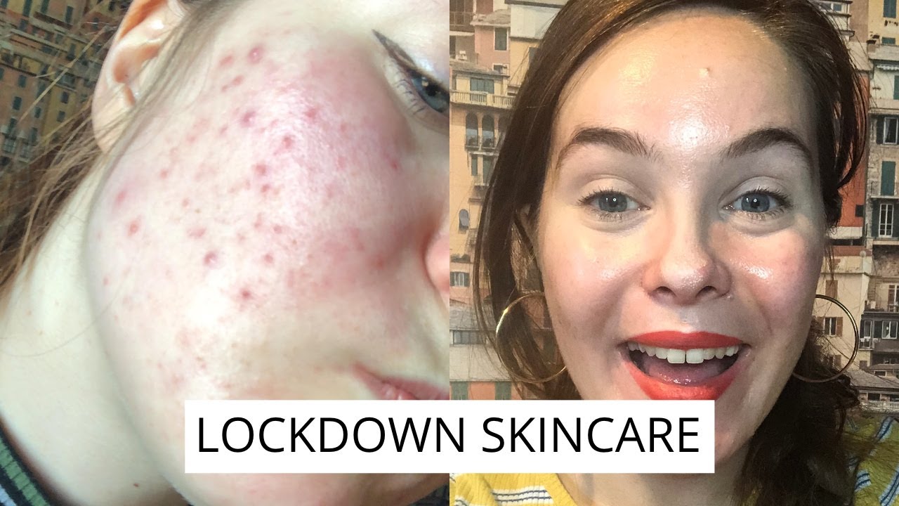 Lockdown Acne Skincare with Dermatica