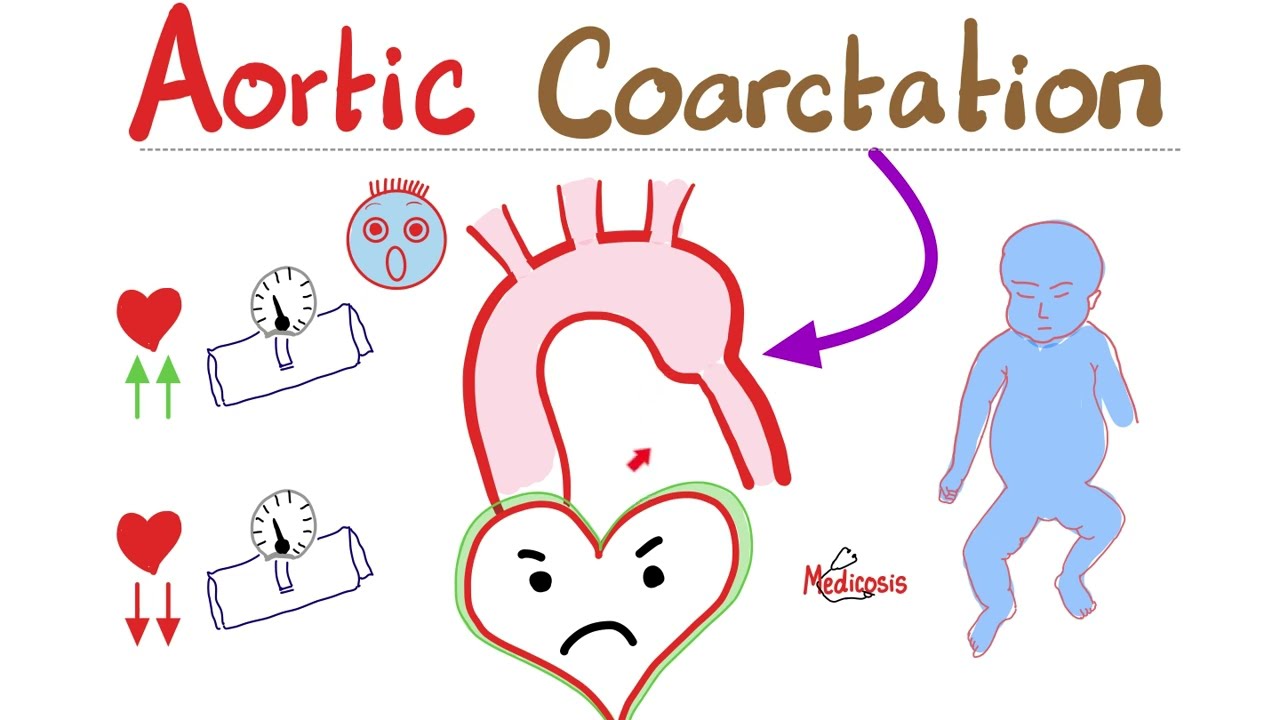 Coarctation of the Aorta - Cardiology Series - Types, Symptoms, Signs, Diagnosis & Treatment