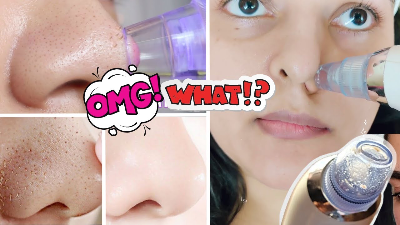 OMG I TRIED THIS 😲😱😳 BLACKHEAD REMOVAL DEVICE FROM AMAZON | Pore + Blackhead SUCKING Vacuum!😲😱😳